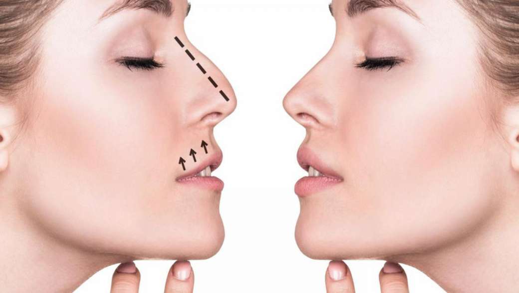 Безоперационная ринопластика, современный способ коррекции носа